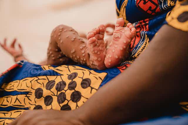 Origine, manifestation et modes de transmission du mpox : un médecin explique et donne des conseils